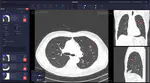 Lung Cancer Detection